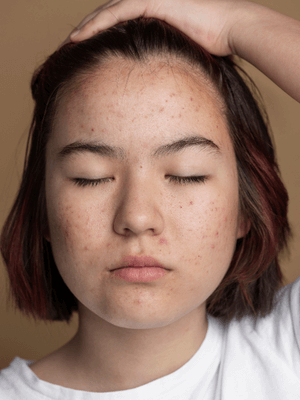 Bosan Berjerawat ? Wajah wanita penuh dengan Jerawat Hormonal dengan ekspresi bosan dimana banyak skincare tidak mengatasi jerawat