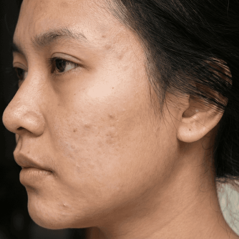 Wajah wanita dimana kondisi jerawat yang meradang mulai berkurang, merah pada wajah juga mereda masuk pada Calming Phase