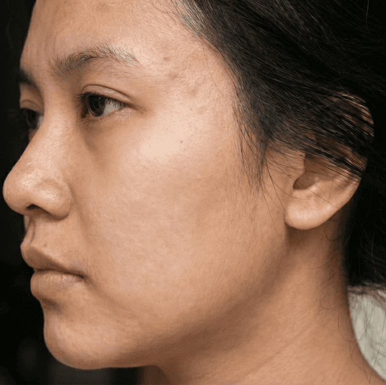 Wajah wanita dimana kondisi jerawat mulai normal, regenerasi sel dan hormon berjalan baik dan bernutrisi masuk pada Regeneration Phase